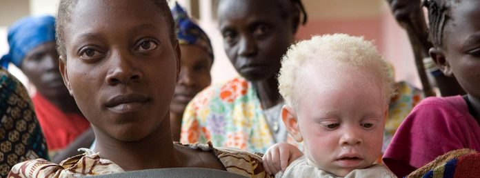 International Albinism Awareness Day Day 2020