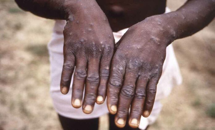 Traditionally, monkeypox patients are considered infectious while they have the characteristic rash and lesions.