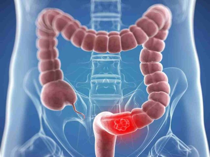 Colon cancer is divided into four stages from I to IV depending upon the physical extent of the cancer within and out of colon.