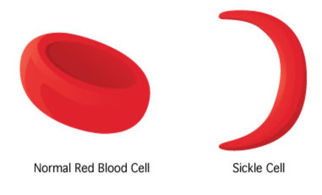 Sickle cell has variance and only the severe form needs a stem cell transplant.