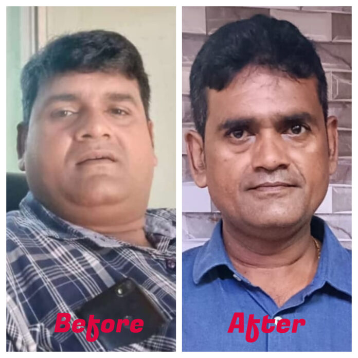 Mumbai Businessman Achieves Remarkable Weight Loss and Improved Mobility After Successful Bariatric Surgery