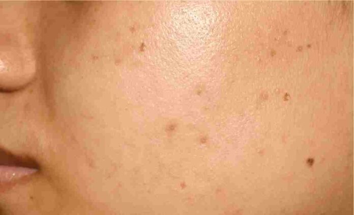 Even though you cannot cure all forms of hyperpigmentation, you can prevent it from developing again.